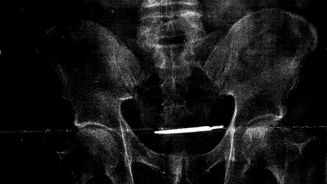 A lawsuit states that a scalpel was left inside 61-year-old United States Army veteran Glenford Turner for four years. (Faxon Law Group)